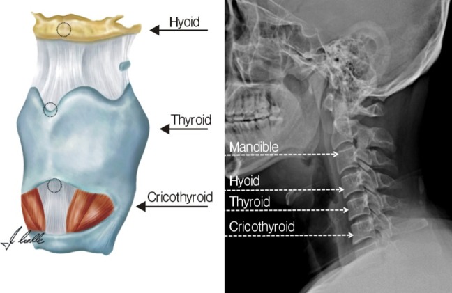 hyoid bone x ray